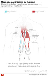 Infográfico mostra como funcionam os corações artificiais da menina Lorena (Foto: Igor Estrela e Alexandre Mauro/G1)